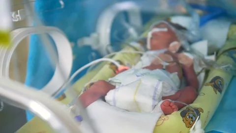 A skinny newborn baby connected to intensive care machinery. Stock Footage 84638800