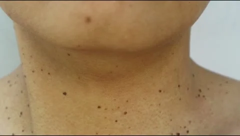 Skintag-1 Stock Footage 280374634