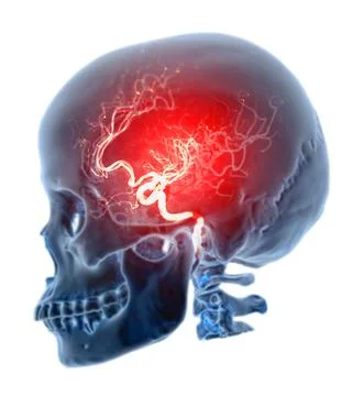 Skull 3D  renderign image of Human fusion  with cerebral angiogram   isolated Stock Illustration