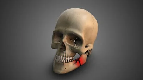 A skull with Broken Jaw イラスト素材
