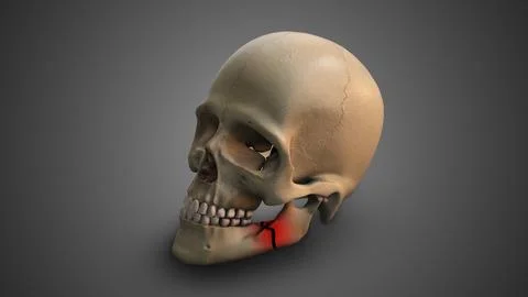 A skull with Broken Jaw Illustration