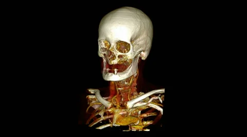 Skull, Enhanced CT Scan Video stock 64800414
