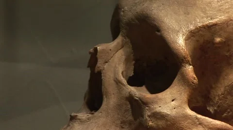 Skull (Head Operation) Stock Footage 2974451