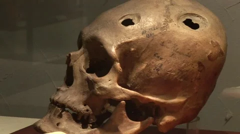 Skull With Head Operation (Peru) Stock Footage 2974424