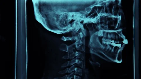 Skull MRI Scan Stock Footage 87162362