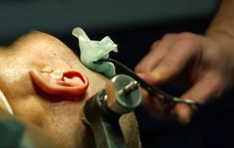 Skull trephination Stock Photos