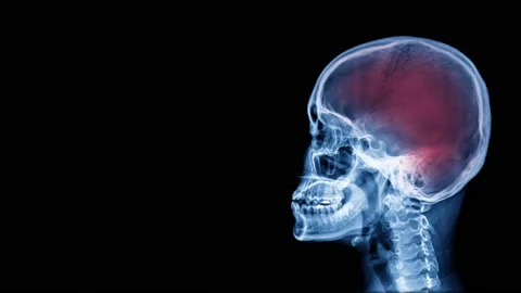 Skull x-ray image Stock Footage 148598725