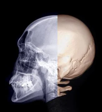 Skull x-ray image of Human lateral view and 3D rendering  image  isolated on  Stock Illustration