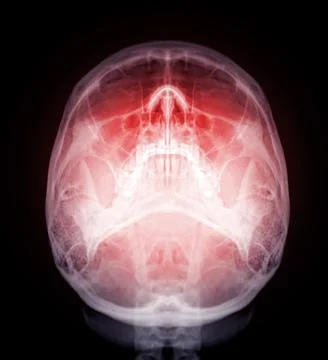 Skull x-ray image of Human skull  water view  isolated on Black Background. Stock Illustration
