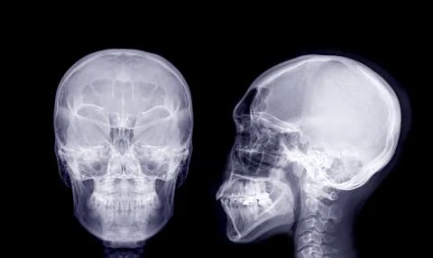 Skull x-ray image of Human AP and lateral view . Illustrazione stock