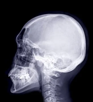 Skull x-ray image of Human lateral view. Stock Illustration