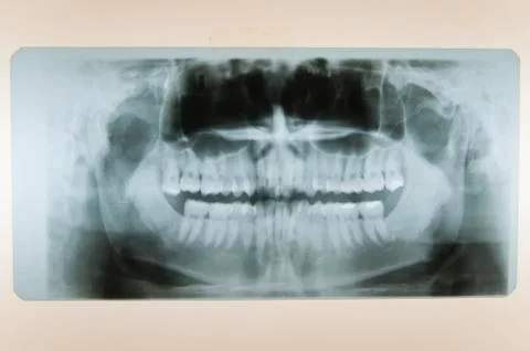 Skull x-ray Stock Photos