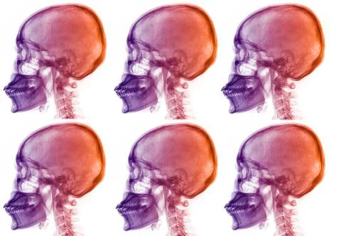 Skull  x-rays image Stock Photos