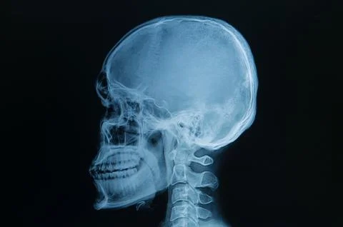 Skull x-rays image Stock Photos