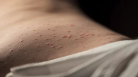A sleeping body part bitten by insects. Allergic reaction on the skin, Stock Footage 244453155