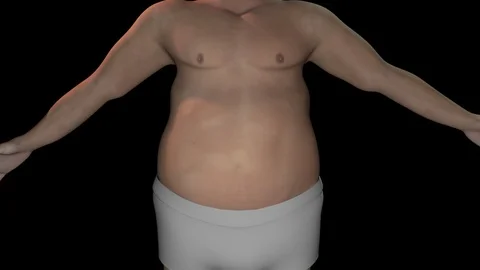 Sleeve Gastrectomy Surgery 스톡 동영상 113271726