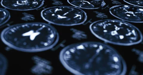 Slider shot of MRI brain scan Stock Footage 339267152