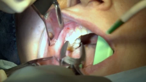 Сlose-up shot of dentist will remove tooth with forceps. 库存影片 118295410