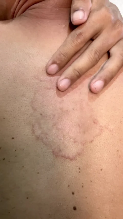 Slow mo close up hand scratching itchy red ringworm rash on back. Video stock 342407331