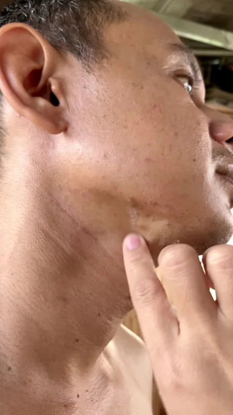 Slow mo close up man applying anti itch ointment cream on neck skin. 스톡 동영상 342407923