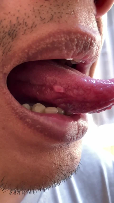 Slow mo close up man checking painful bump on side of tongue. 스톡 동영상 342578683