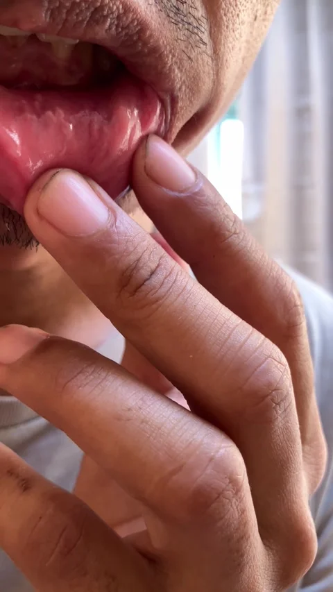 Slow mo close up man checking inner lower lip for canker sore. 動画素材 342578725