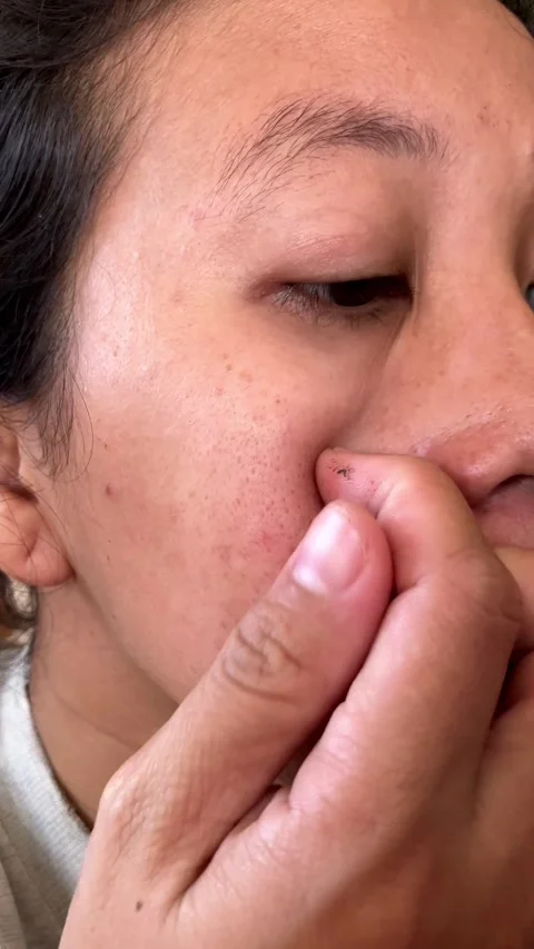 Slow mo close up woman feeling onset of blackheads and dark spots on cheek. Vídeo Stock 342408972
