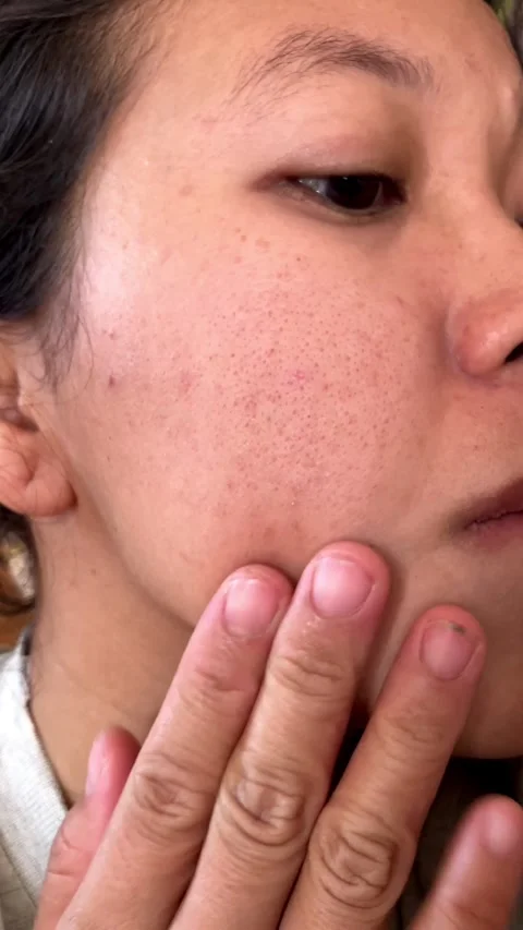Slow mo close up woman feeling onset of blackheads and dark spots on cheek. Stock Footage 344122456