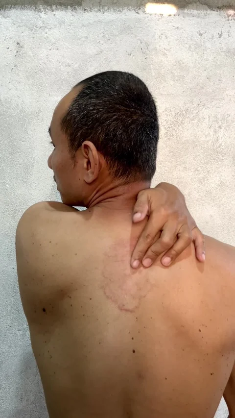 Slow mo man scratching itchy red ring rash on his upper back. Stock Footage 342407323