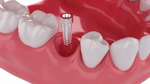 Slow motion Close up Process Implant Teeth. 3D animation. 4K Stock Footage 122551288
