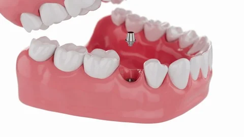 Slow motion Close up Process Implant Teeth. 3D animation. 4K Stock Footage 122551289