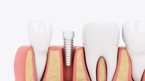 Slow motion Close up Section Process Implant Teeth. 3D animation. 4K Stock Footage 122549074