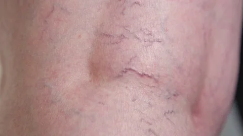 SLOW MOTION CLOSE UP: Unknown lady's curved varicose veins running down her leg. Stock Footage 83079261