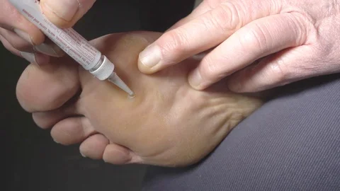 Slow motion – Man applying gel to treat a foot verruca. Stock Footage 106457031