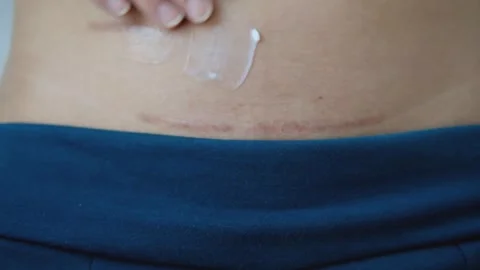 Slow motion using cream to care for postpartum surgical wounds 스톡 동영상 253439126