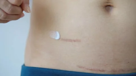 Slow motion using cream to care for scars after appendix surgery Stock Footage 253439128