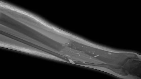Slow Motion X-ray Leg Break Stock Footage 42714996