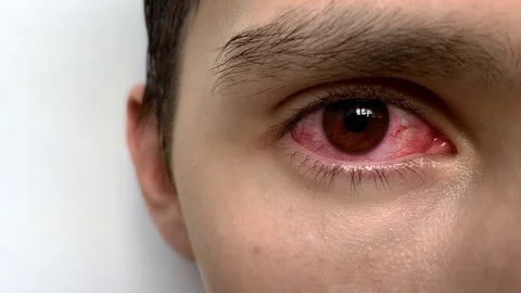 Slow motion.Conjunctivitis red eye. Close up of an irritated red bloodshot eye. Stock Footage 112020773