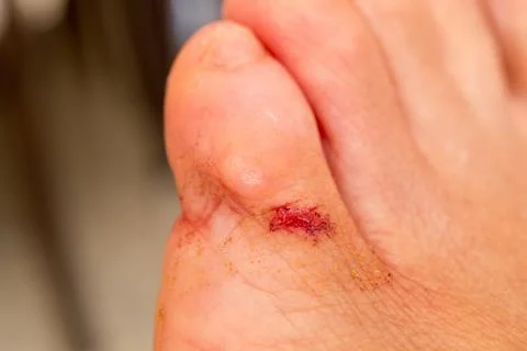 Small Cut on Toe Stock Photos