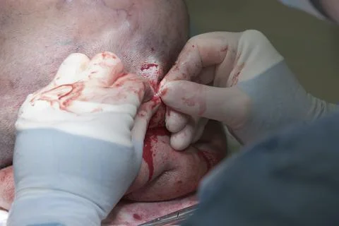Small Details In Surgery Stockfoto's