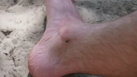 Small Fly Biting Human Ankle Skin While Resting on Sandy Beach Stock Footage 342180958