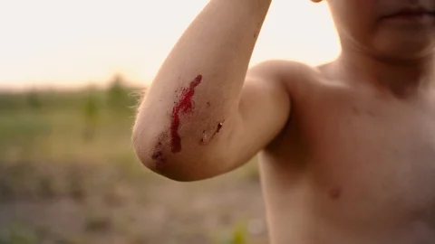 A small fresh scratch on the child's hand, a trauma on the boy's elbow after the Video stock 94232275