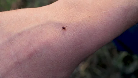 Small Insect Parasite Mite Crawls On a Man's Hand. Tick on the Skin Close Up Video stock 131080170