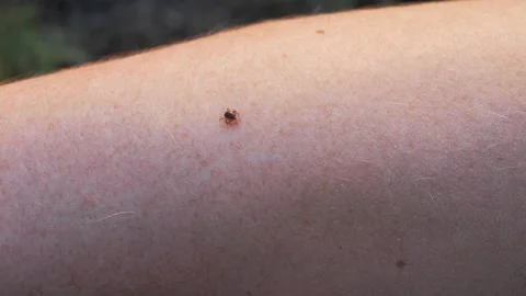 Small Insect Parasite Mite Crawls On a Man's Hand. Tick on the Skin Close Up Stock-Footage 131083926