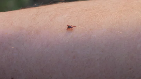 Small Insect Parasite Mite Crawls On a Man's Hand. Tick on the Skin Close Up Video stock 131090643