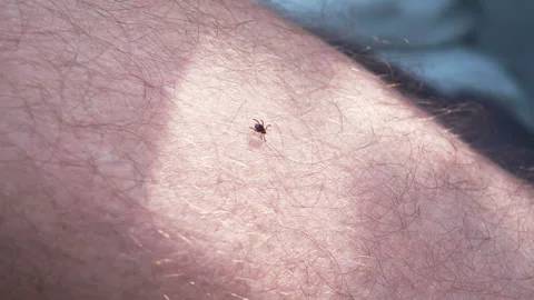 Small Insect Parasite Mite Crawls On a Man's Leg. Tick on the Skin Close Up Video stock 155107120