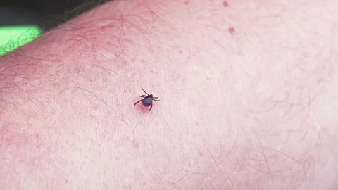 Small Insect Parasite Mite Crawls On a Man's Leg. Tick on the Skin Close Up Video stock 155110813