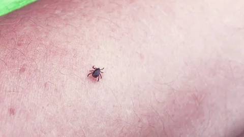 Small Insect Parasite Mite Crawls On a Man's Leg. Tick on the Skin Close Up 스톡 동영상 155110868
