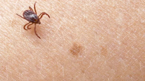Small Insect Parasite Mite Crawls On a Man's Arm Macro Shot. Tick on the Skin 動画素材 156037760