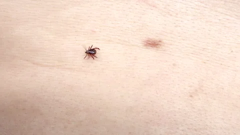 Small Insect Parasite Mite Crawls On a Man's Skin Macro Shot. Tick in Hand Close Video stock 244655666